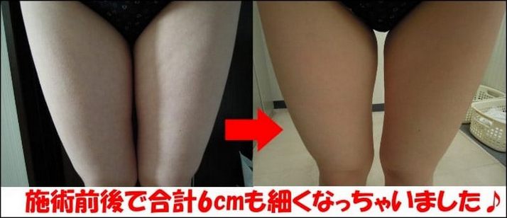 「TAKANO式キャビボディ」 お試しコースで感じた効果