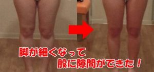 「メソセルライト撃退コース」ビフォーアフター